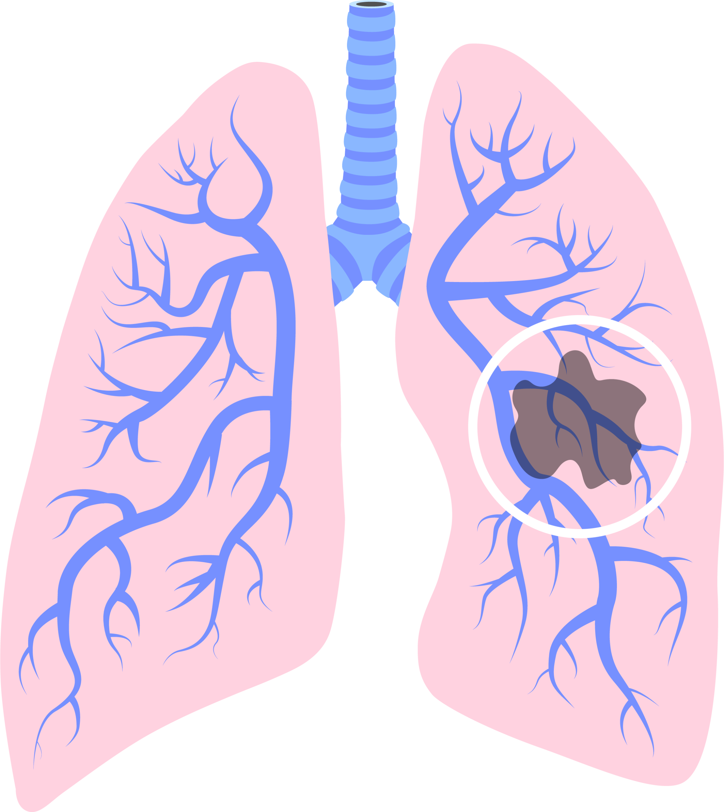 Jak se vysetruje rakovina plic?